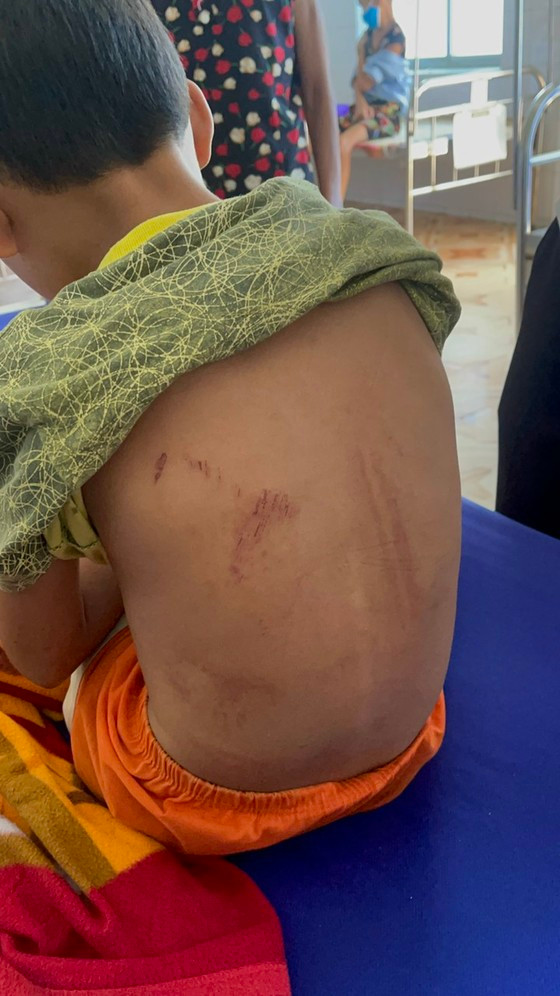 Quảng Bình: Một cháu bé bị cha dùng xăng và rơm đốt  ảnh 1