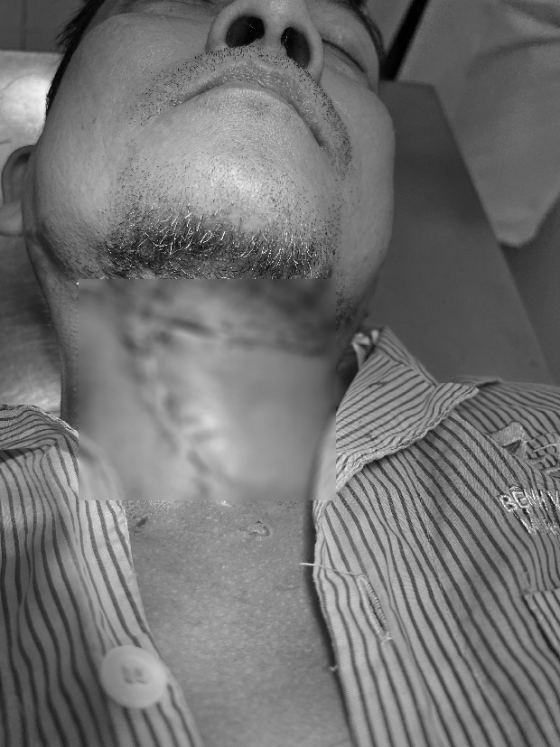 Người đàn ông ở TP.HCM đau răng 10 ngày không khỏi, bác sĩ mở vùng dưới hàm phát hiện cả ổ mủ bốc mùi - Ảnh 1.