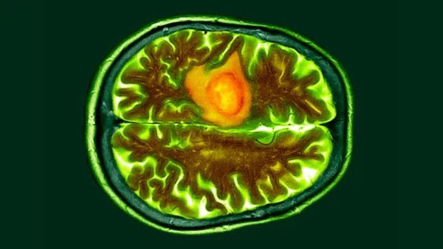 Glioblastomas là dạng ung thư não nguy hiểm nhất. Một trong những khối u này được hiển thị trong hình ảnh quét não có màu cam. (Ảnh: DR P. MARAZZI)