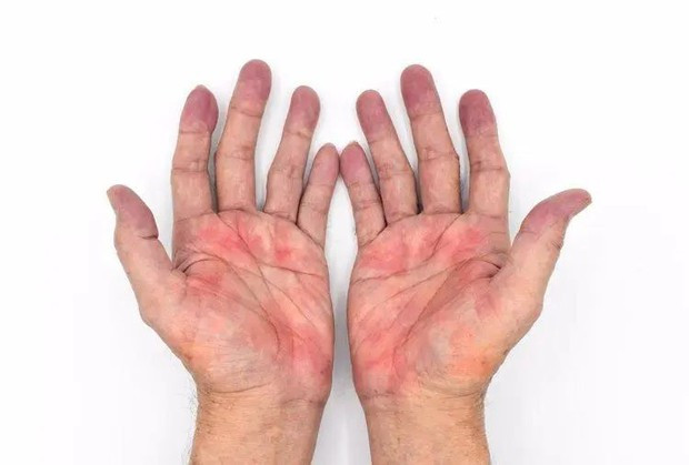 Bác sĩ ung bướu tiết lộ điềm báo ung thư lộ rõ trên bàn tay: Có 3 điểm bất thường nên đi khám khẩn cấp - Ảnh 2.