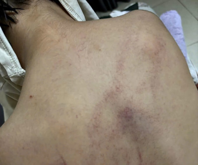 Các vết thương trên lưng con của chị Trinh hôm 5/7 đi học về. Ảnh: Nhân vật cung cấp