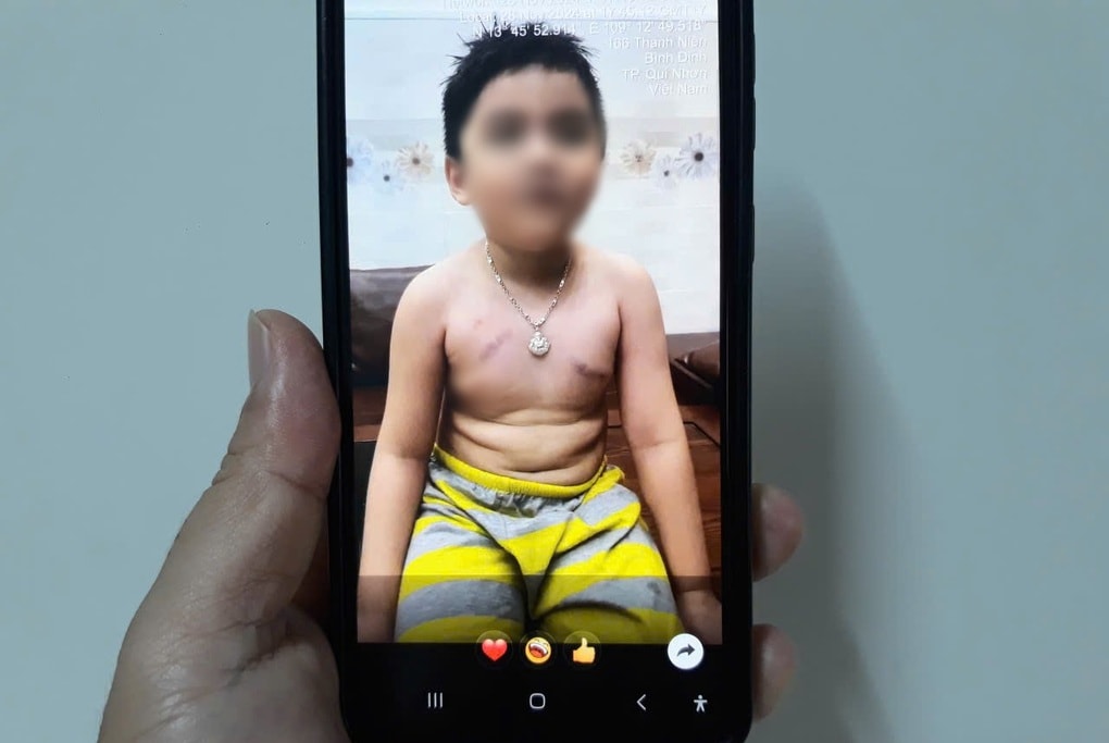 Phụ huynh tố cô giáo nhéo trẻ bầm ngực, trường nói không có bạo hành - 1