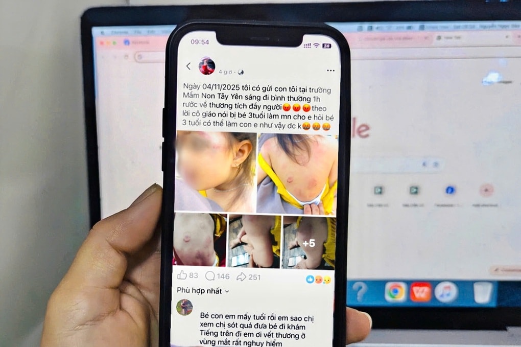 Bé gái 3 tuổi bị nhiều vết bầm tím, dấu răng trên người sau giờ học - 1