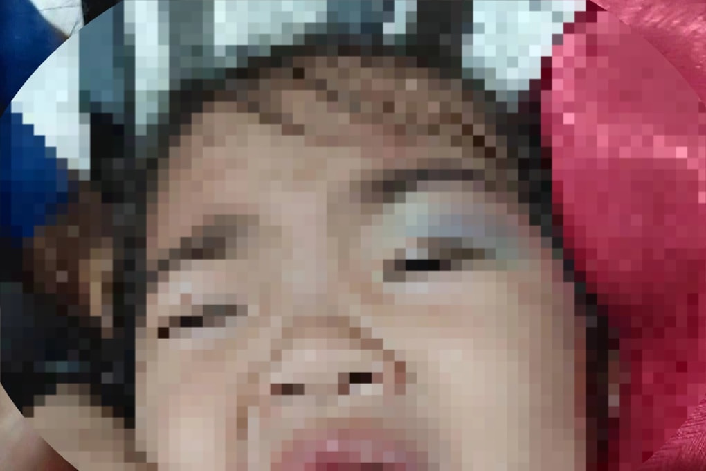 Bé gái 3 tuổi bị nhiều vết bầm tím, dấu răng trên người sau giờ học - 2