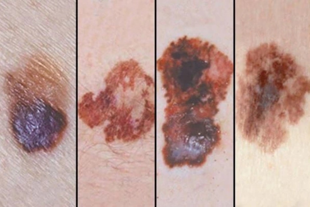 Thuốc Pembroria của Nga được chỉ định cho các loại ung thư gì? - 2