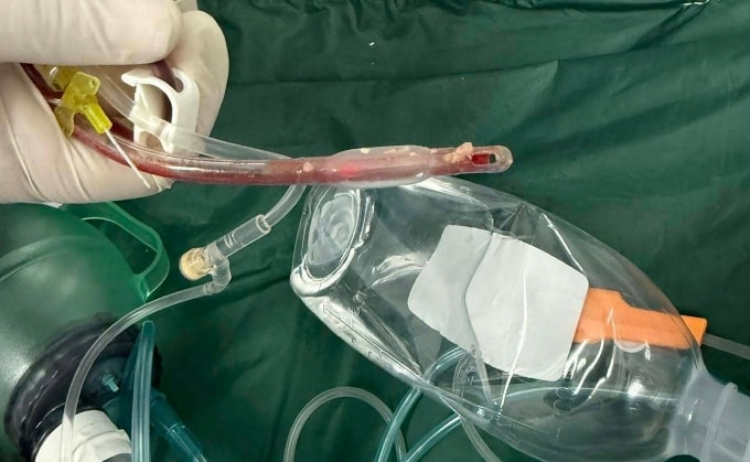 Thức ăn nghẹt dính vào ống nội khí quản sau khi hồi sinh tim phổi thất bại. Ảnh: Bác sĩ cung cấp