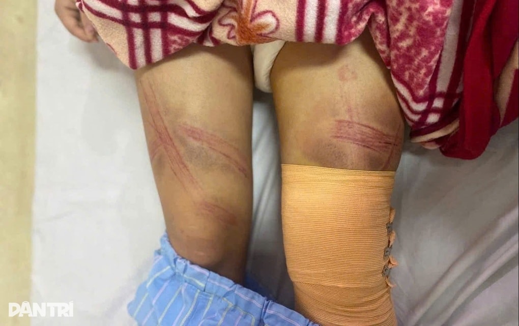 Nữ sinh lớp 7 nhập viện với nhiều vết bầm trên cơ thể - 1