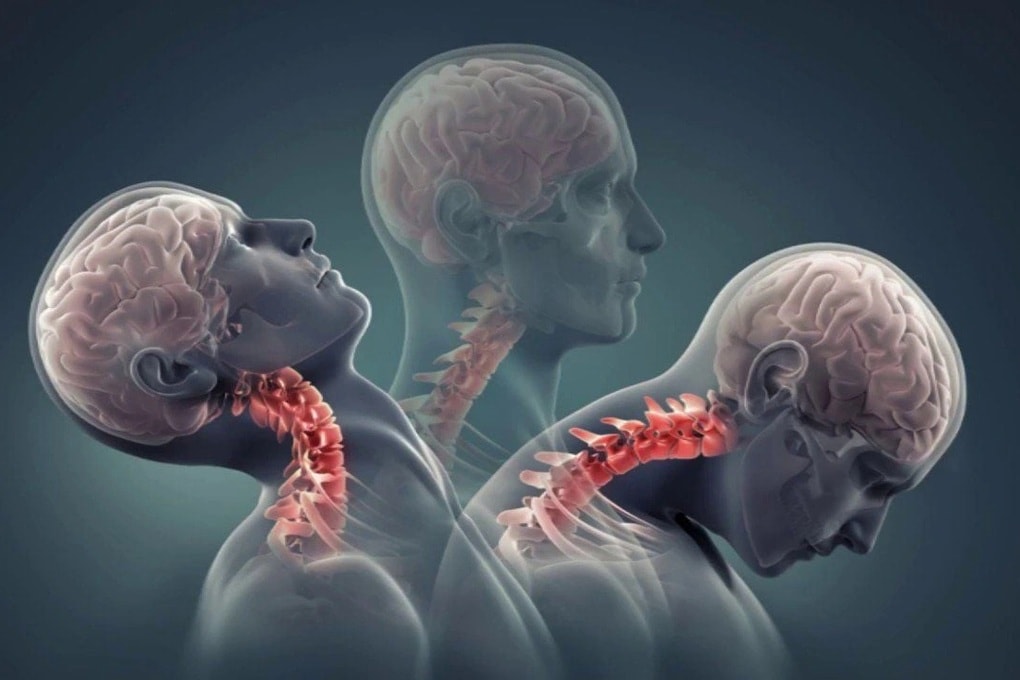 Thói quen của nhiều người Việt bào mòn cột sống cổ - 1