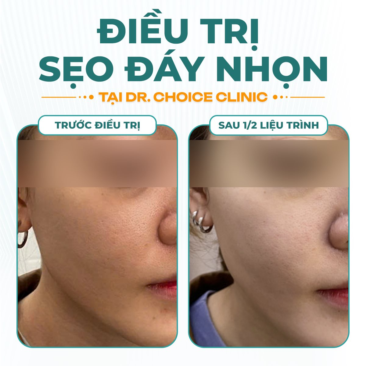 dieu-tri-seo-chan-long-day-nhon-hieu-qua-hcm.png