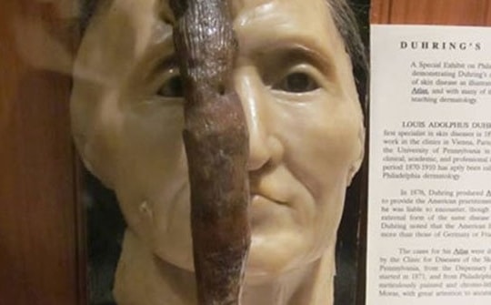 Bí ẩn về những người bị... mọc sừng