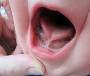 Trẻ bị nhiễm trùng miệng vì chữa chậm nói bằng gai bưởi
