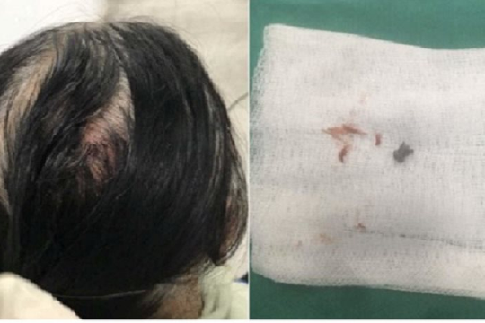 Hà Nội: Nữ công nhân nghi bị đạn súng hơi bắn vào đầu