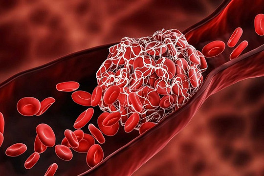 Độ nhớt của máu có thể liên quan tới nguy cơ tử vong do COVID-19
