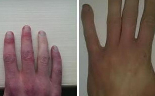 Người đàn ông 38 tuổi có bàn tay chuyển sang màu xanh, đỏ mỗi khi tức giận