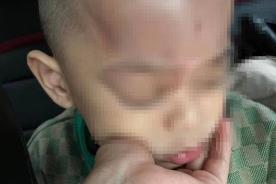 Đà Nẵng: Xác minh thông tin trẻ bị bạo hành ở trường mầm non