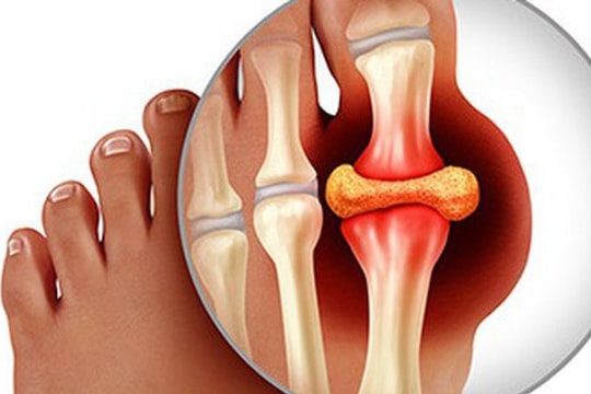 Nhận biết tác nhân gây đau với người bệnh gout