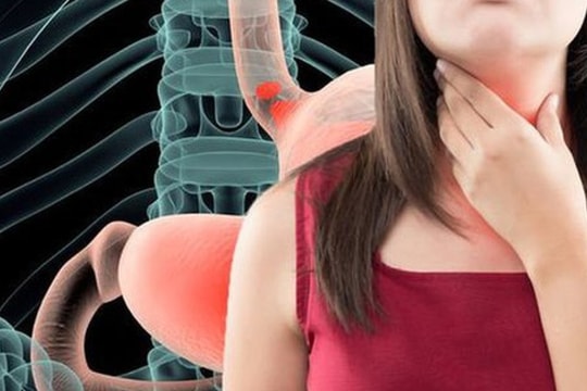 Cách chữa ợ chua nóng sau ăn