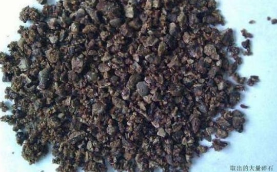 Lấy ra 420 viên sỏi khỏi thận người đàn ông