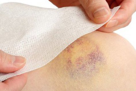 Xuất hiện vết bầm tím trên da là dấu hiệu của bệnh gì?