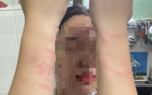 Điều tra vụ việc thiếu nữ 17 tuổi bị mẹ ruột đánh gây thương tích ở TP Thủ Đức