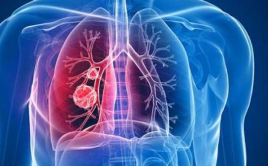 Những ai nên sàng lọc ung thư phổi?