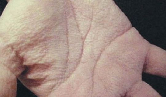 Dấu hiệu ung thư biểu hiện trên bàn tay