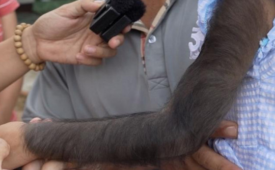 Bé gái Ninh Thuận có 'cánh tay khỉ' da đen mọc đầy lông