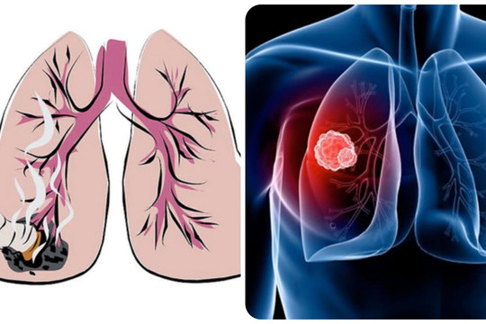 Ung thư phổi giai đoạn đầu và các dấu hiệu nhận biết