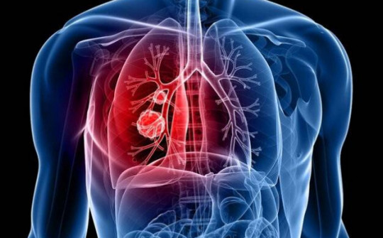 3 triệu chứng tưởng cảm lạnh nhưng là ung thư phổi