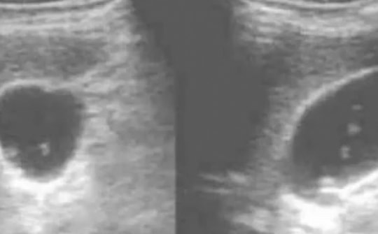 Gan trái của đàn ông bị "rỗng", cần hết sức lưu ý 2 thói quen ăn uống này