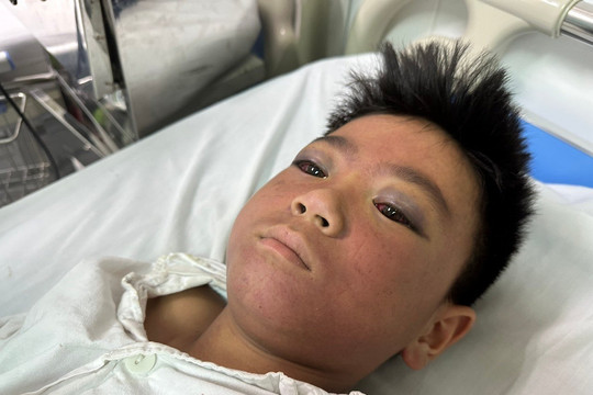 Xót xa cậu bé H’Mông 10 tuổi bị công nông chèn lên người, khuôn mặt đổi màu đỏ