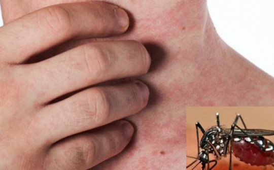 Những biểu hiện cho thấy mắc sốt xuất huyết vào giai đoạn nguy hiểm