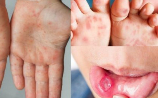 Dịch tay chân miệng bùng phát, xuất hiện chủng virus dễ gây bệnh nặng