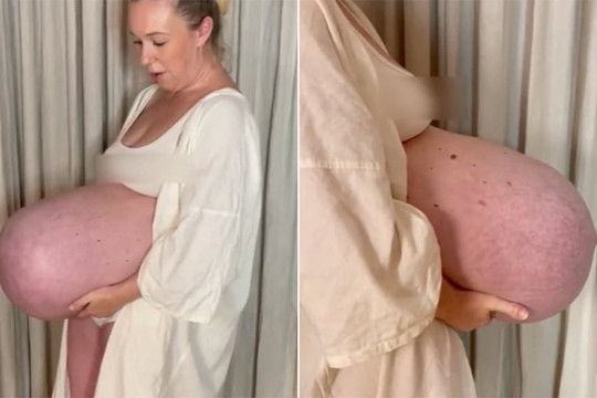 Chiếc bụng bầu kỳ quặc khiến thai phụ 'sốt xình xịch' trên mạng xã hội