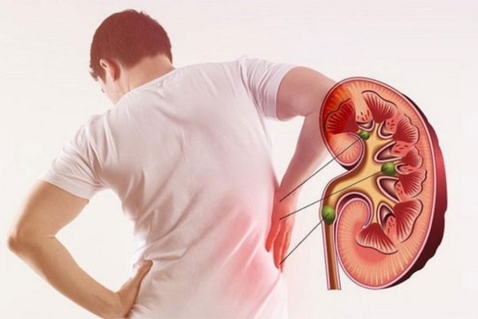 4 thói quen mỗi sáng âm thầm phá huỷ thận của bạn