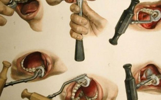 Lịch sử nhổ răng: Thời cổ đại như hình thức tra tấn đến sự phát triển của nha khoa hiện đại