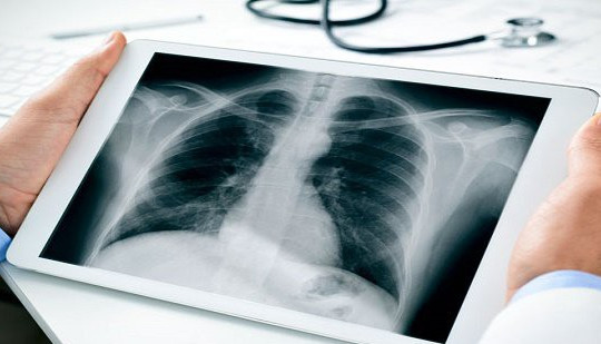 4 ''thủ phạm'' gây ra ung thư phổi: Số 1 nhiều người Việt vẫn đang duy trì