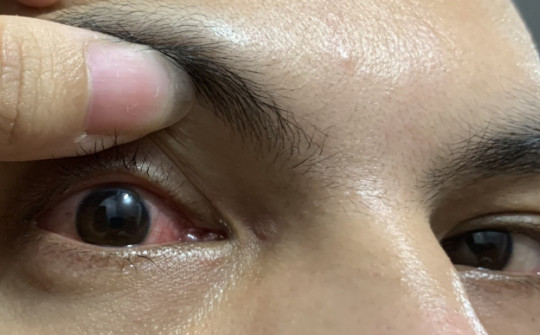 Dịch đau mắt đỏ lây lan nhanh, nhiều người biến chứng nặng