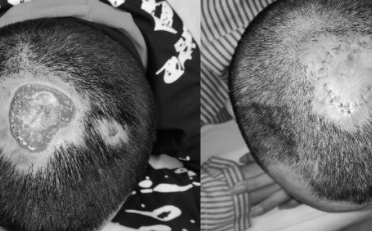 2 bệnh nhân ở Hà Nội bị hoại tử, lở loét da đầu vì tẩy tóc