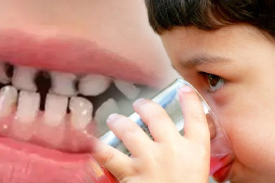 Bé trai 14 tuổi gần như mất cả hàm răng, phải dùng răng giả do nghiện một loại nước nhiều người yêu thích