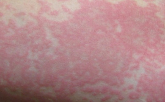 Cô gái 20 tuổi tử vong vì tự điều trị sốt xuất huyết tại nhà