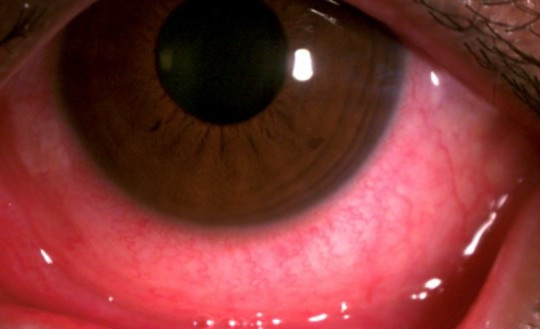 Dịch đau mắt đỏ lây lan mạnh: Chuyên gia khuyến cáo không tự ý mua thuốc tra mắt
