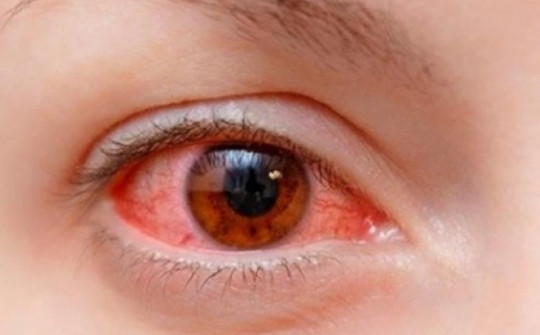 Nhiều gia đình nghỉ học, nghỉ làm vì đau mắt đỏ, Bộ Y tế khuyến cáo 5 biện pháp