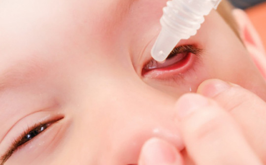 Đau mắt đỏ không nhỏ kháng sinh, cha mẹ cần làm gì để trẻ nhanh hồi phục?