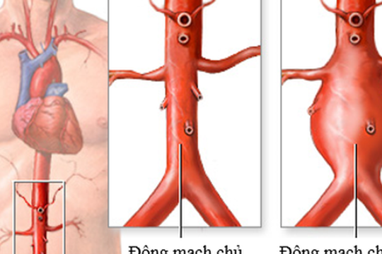 Căn bệnh khiến nghệ sĩ Bảo Anh 'Người đẹp Tây Đô' qua đời ở tuổi 68 mắc phải nguy hiểm thế nào?