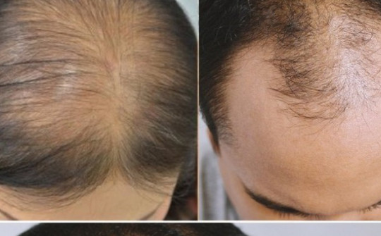 Rụng tóc nhiều chữa mãi không khỏi, nguy cơ hói phải làm sao?