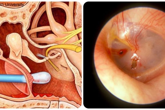 Hậu quả của việc thường xuyên ngoáy tai