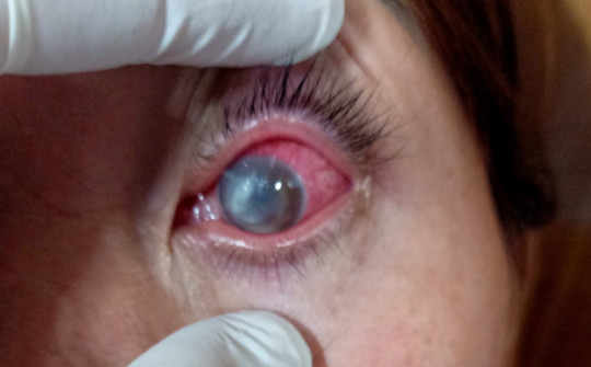 Tự mua thuốc điều trị đau mắt đỏ, người phụ nữ bị loét giác mạc