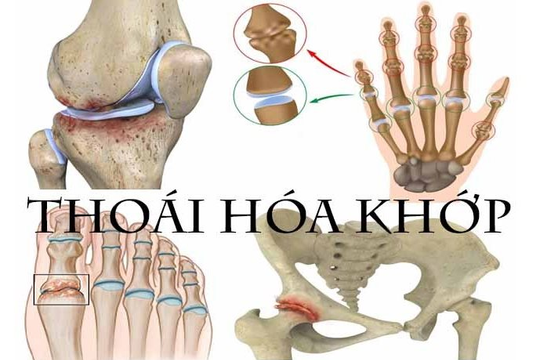 Bệnh thoái hoá khớp: dấu hiệu và cách điều trị