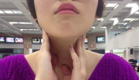 Cô gái 21 tuổi bất ngờ phát hiện ung thư nhờ dấu hiệu ít người chú ý trên cổ
